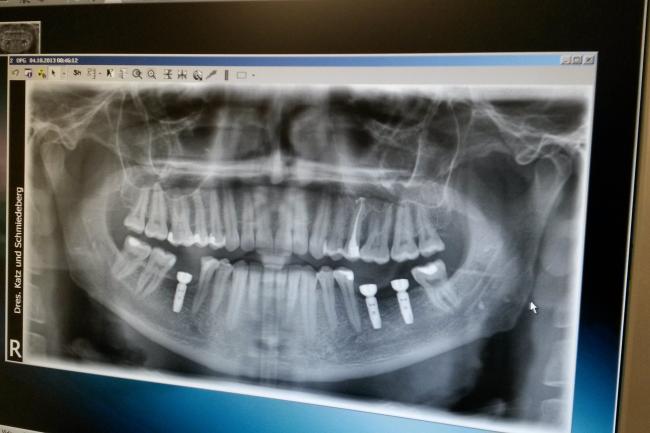 Снимок зубных протезов вставленных немецким хирургом.